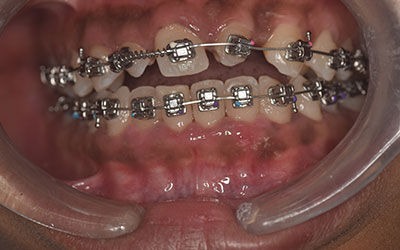 Black Spot on Tooth